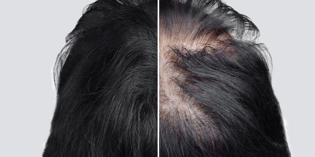 Alopécie : comment favoriser la repousse des cheveux ?