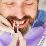 Quelle est la durée de vie d'une facette dentaire ?