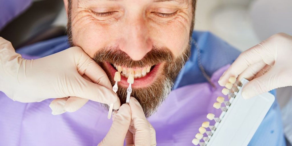 Quelle est la durée de vie d’une facette dentaire ?